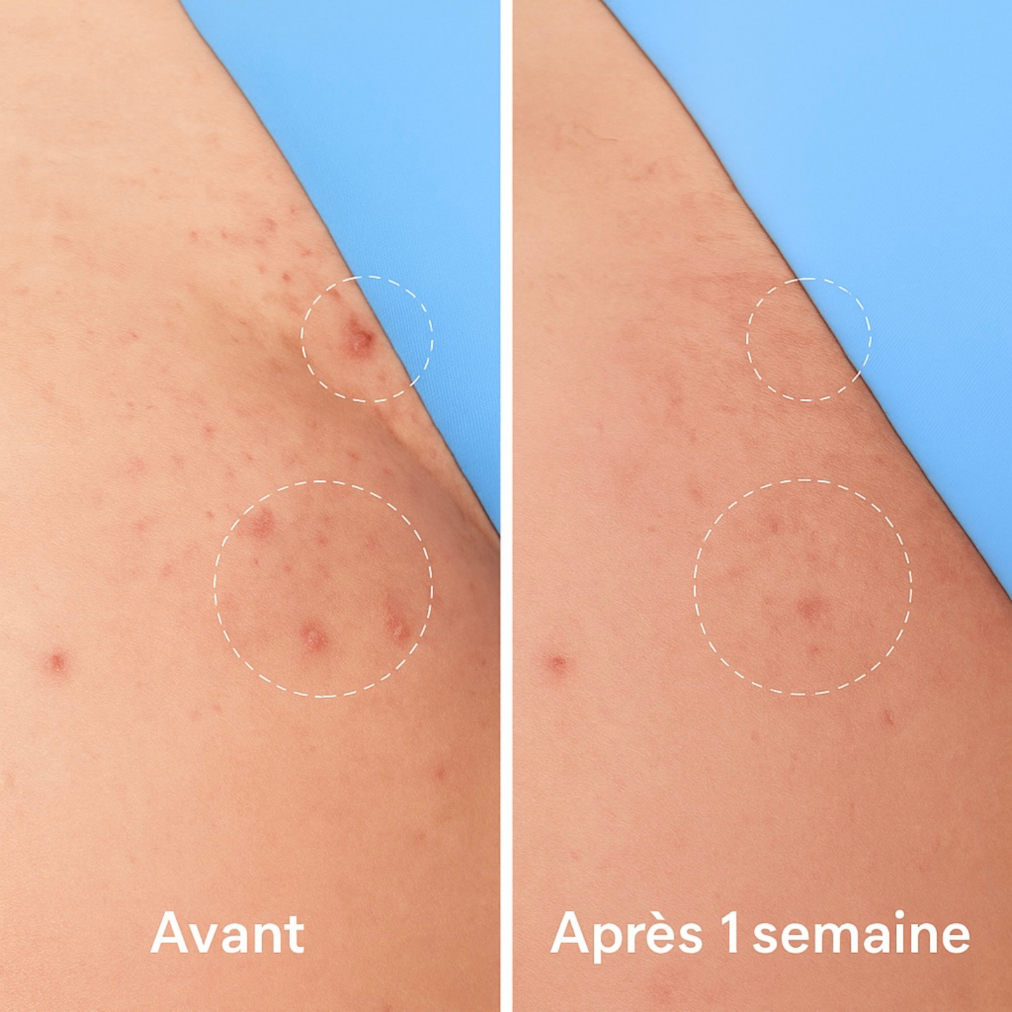 ROLL-ON ANTI POILS INCARNÉS™ barbes, visage, maillot et corps .